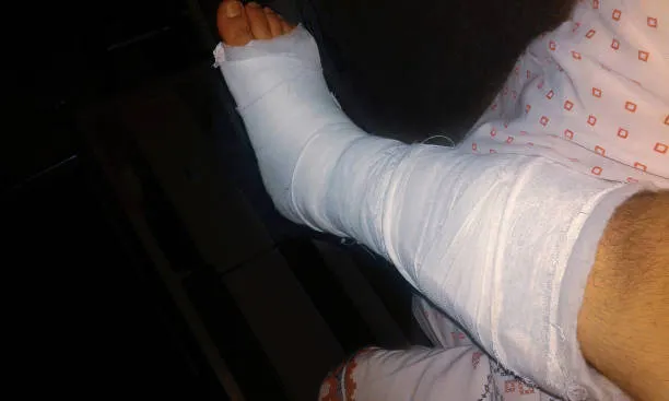Kumpulan Foto Kaki Diperban Seperti Habis Kecelakaan 16 kaki diperban
